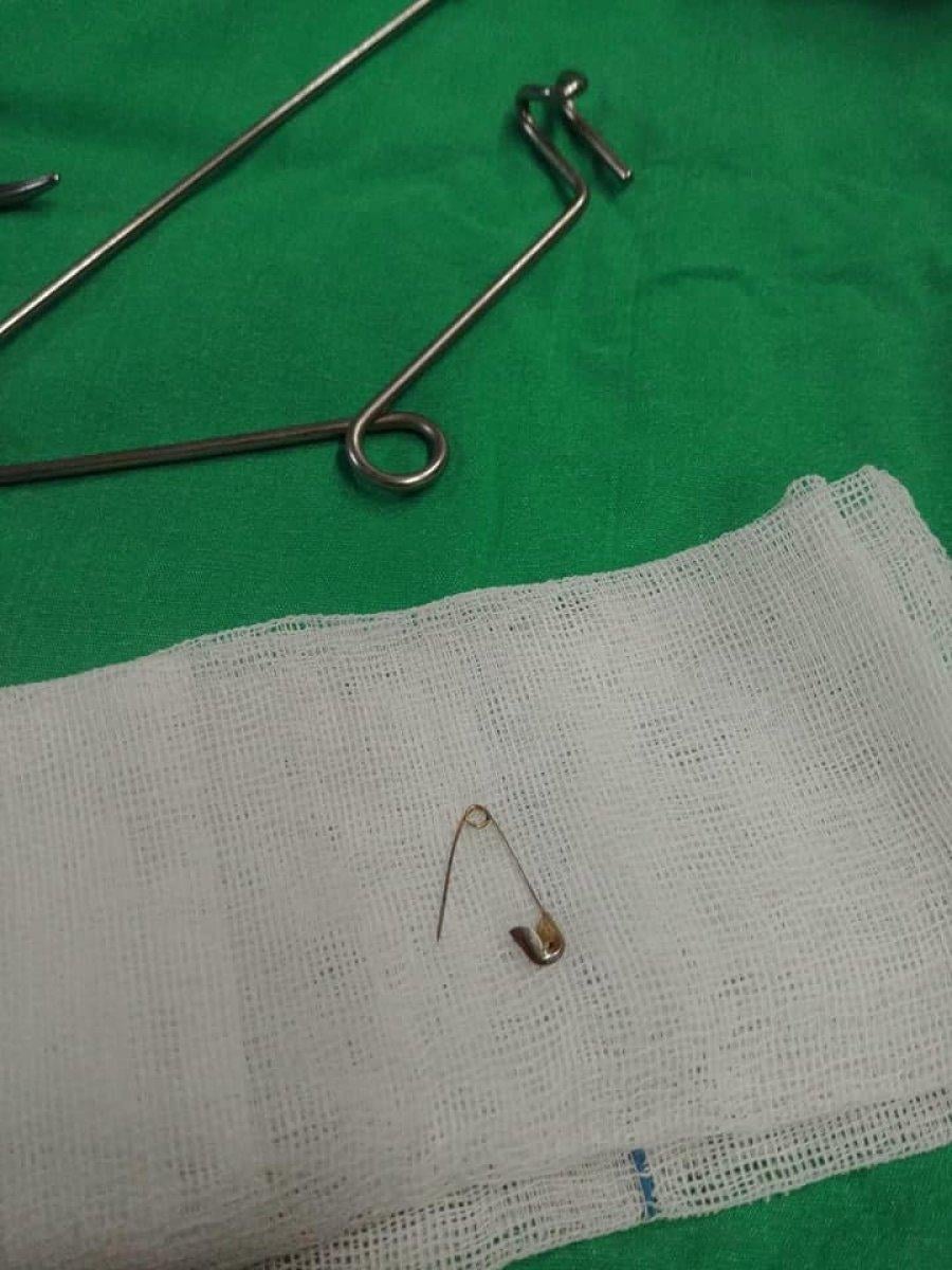 Tekirdağ'da, bebeğin yemek borusundan çengelli iğne çıktı