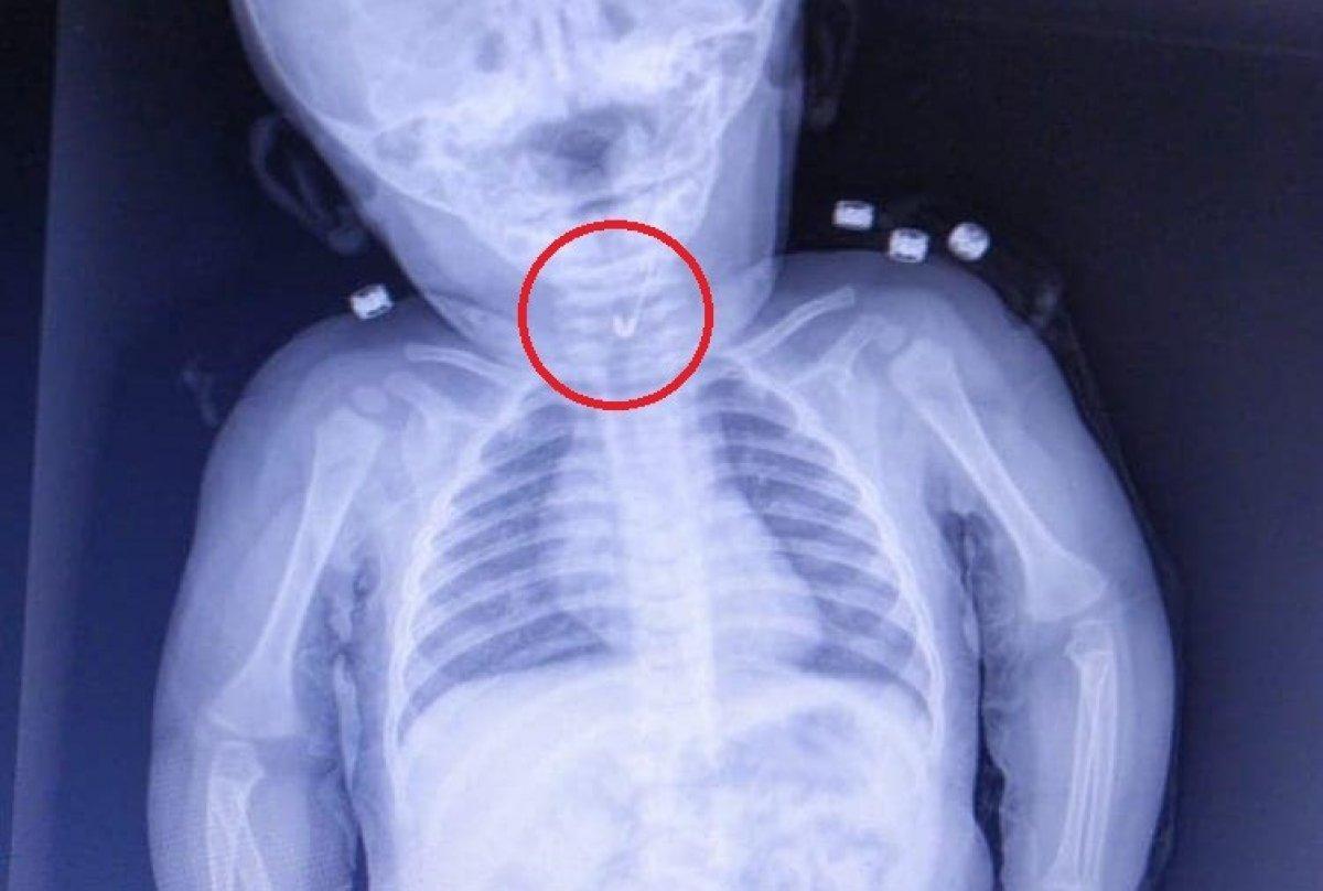 Tekirdağ'da, bebeğin yemek borusundan çengelli iğne çıktı