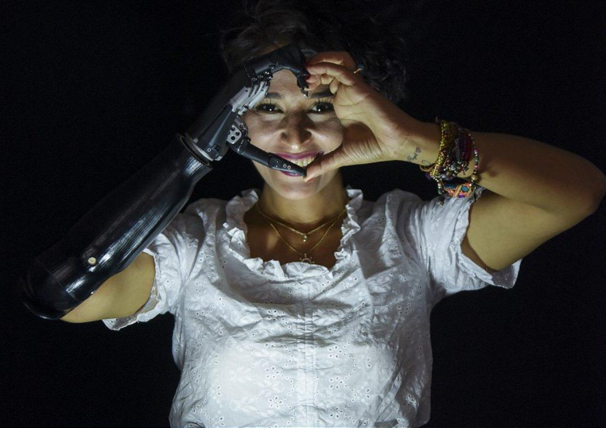 Gaziantepli Zübeyde, biyonik koluyla hayata tutundu