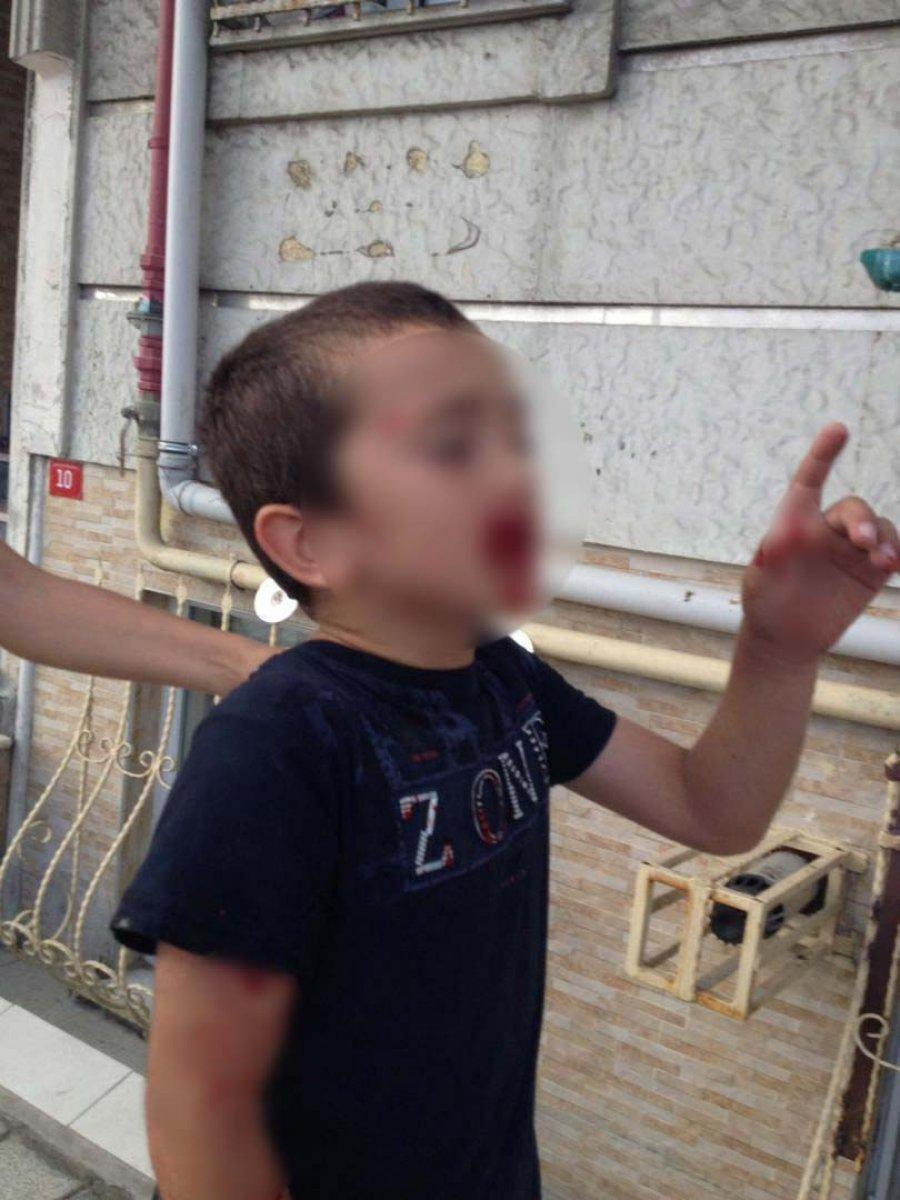 Sultangazi'de 8 yaşındaki Ubeyde'ye köpek saldırdı