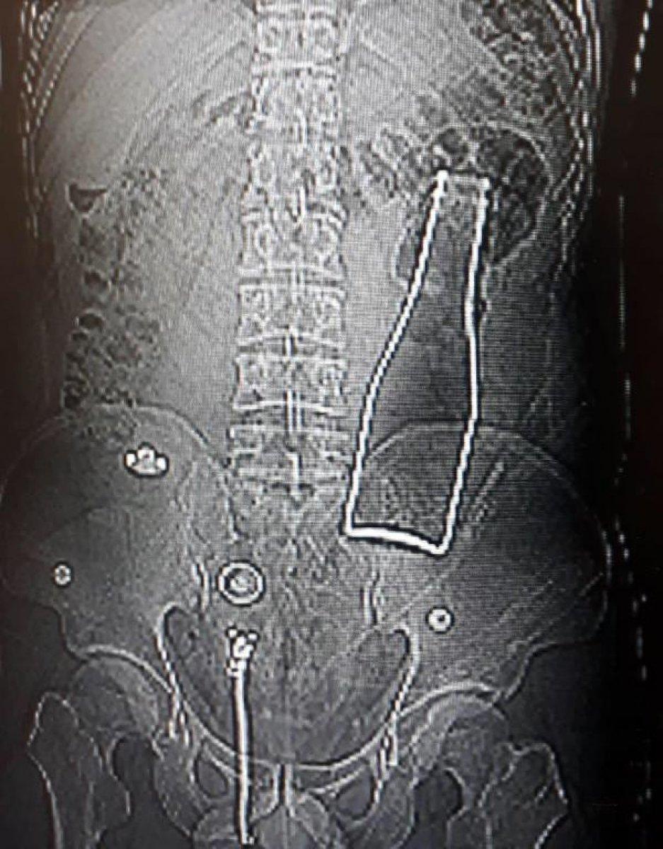 Karaman'da karın ağrısıyla hastaneye gitti, şişe çıktı