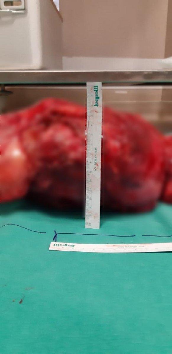 İstanbul’da yaşlı adamın karnından 10 kiloluk tümör çıktı