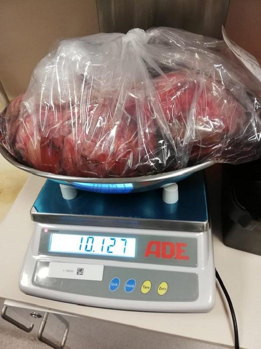 İstanbul’da yaşlı adamın karnından 10 kiloluk tümör çıktı