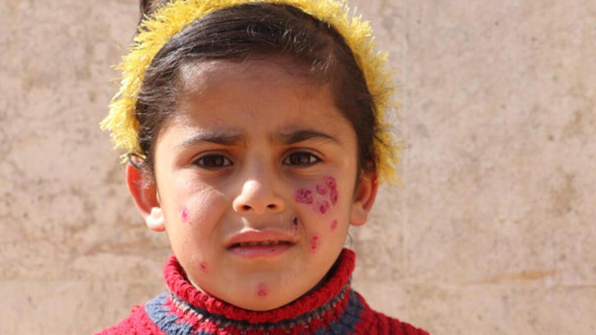 Şark çıbanı nedir