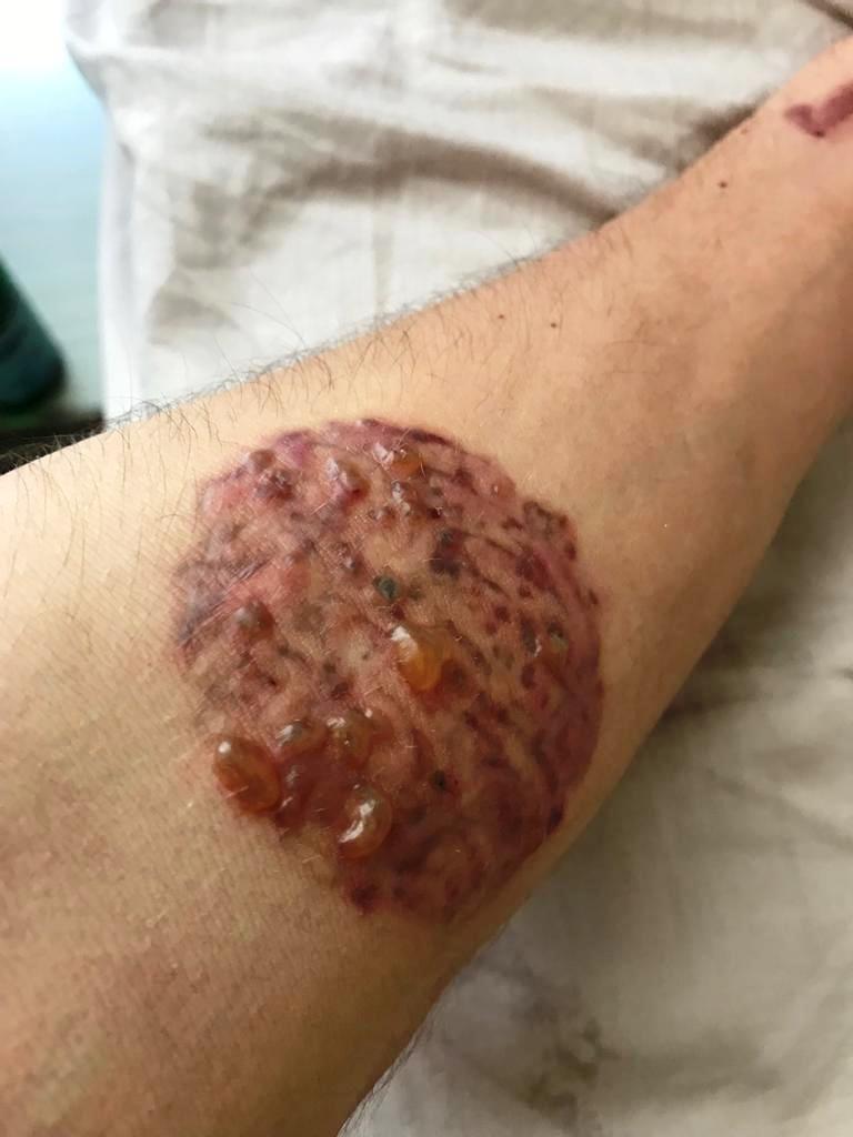 Muğla'da dövmelerini sildirmek isterken cildi çürüdü