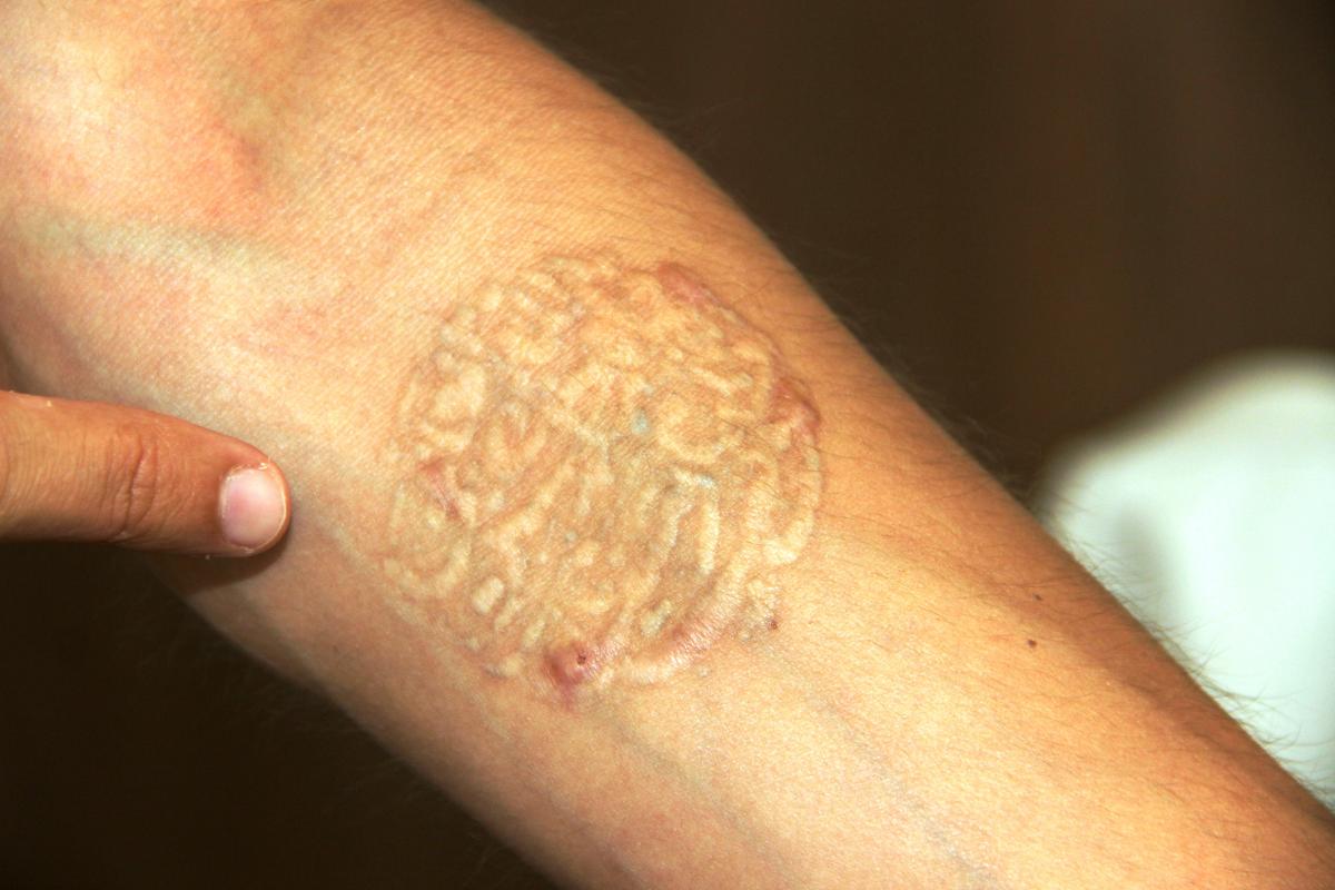 Muğla'da dövmelerini sildirmek isterken cildi çürüdü