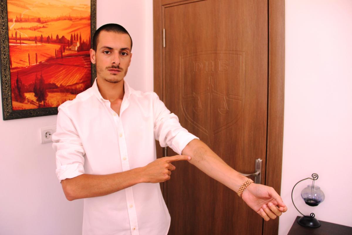 Muğla'da dövmelerini sildirmek isterken cildi çürüdü