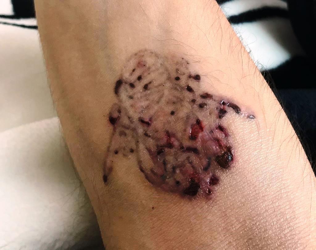 Muğla'da dövmelerini sildirmek isterken cildi çürüdü