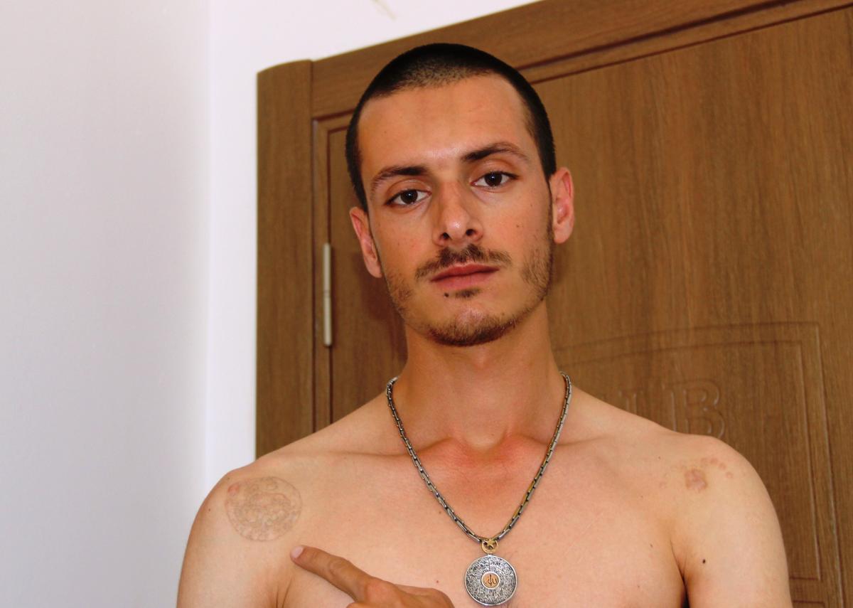 Muğla'da dövmelerini sildirmek isterken cildi çürüdü