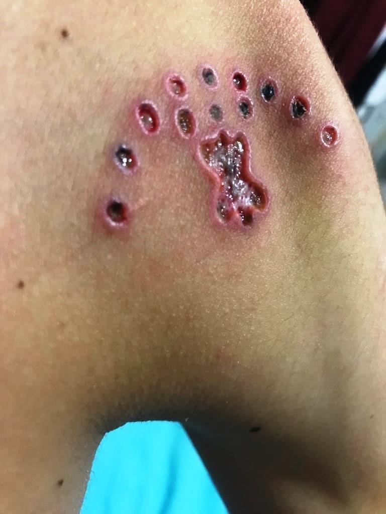 Muğla'da dövmelerini sildirmek isterken cildi çürüdü