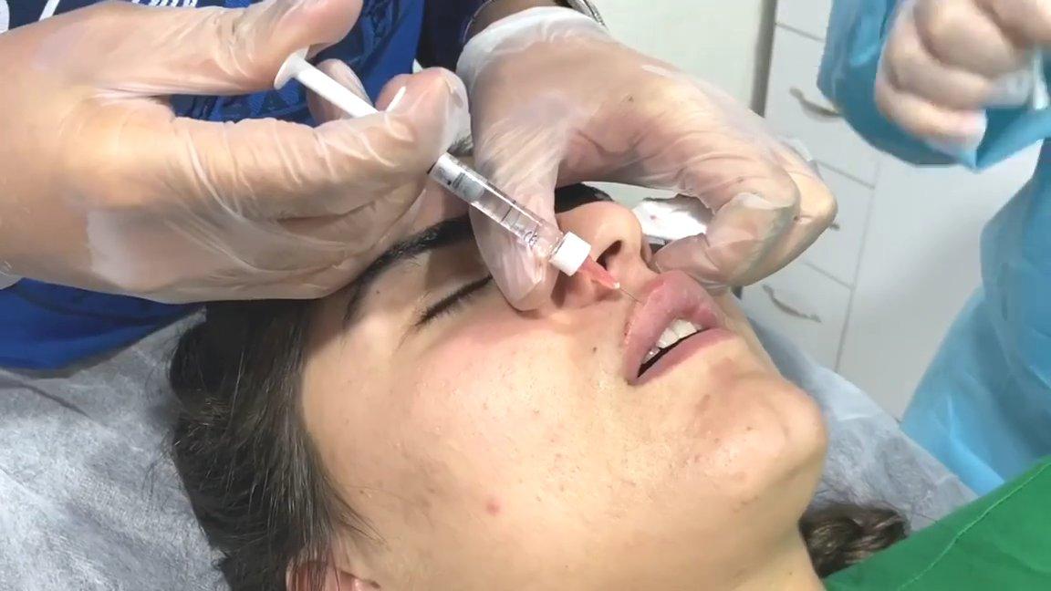 Hanife Gürdal, dudaklarını büyüttü