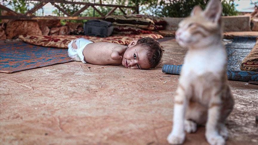 Kolları ve bacakları olmayan Muhammed bebek yardım bekliyor