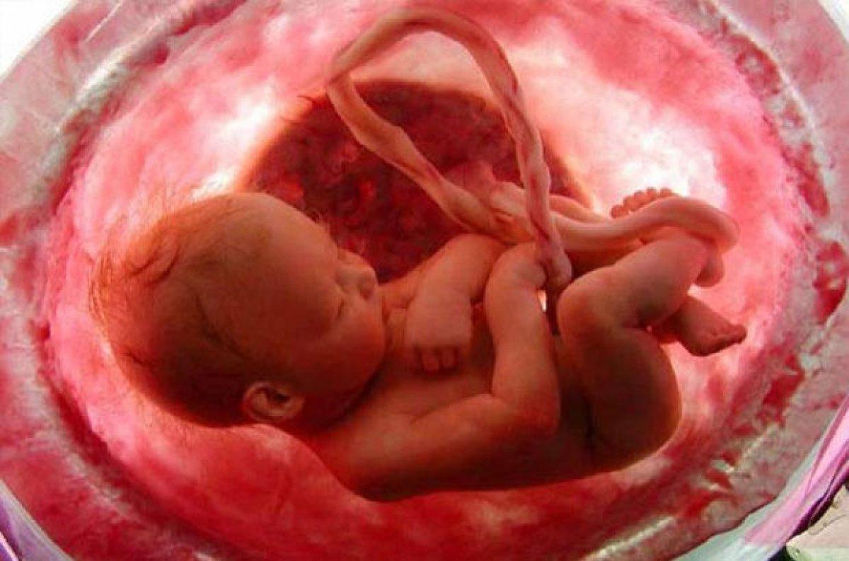 Hirschsprung hastalığı nedir