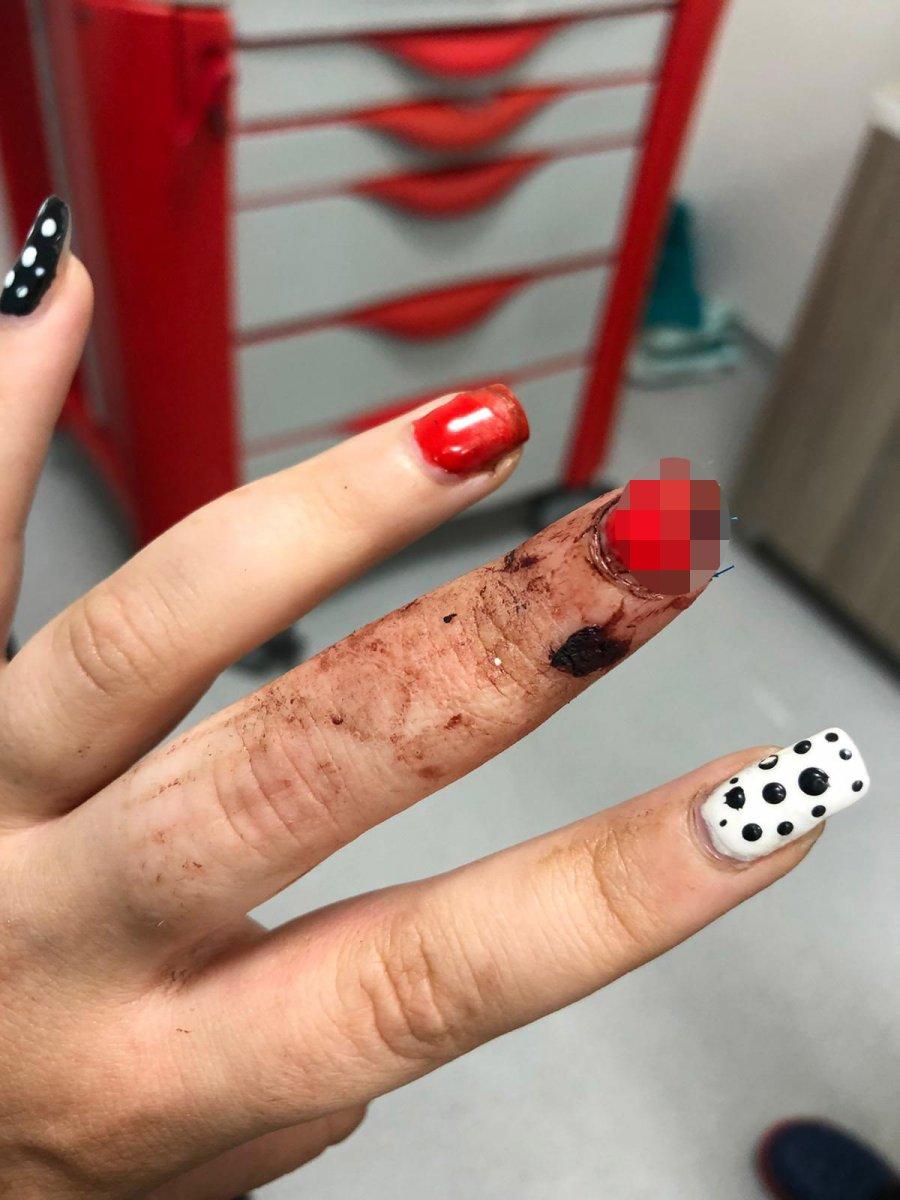 Sinop'ta sandalyeye eli sıkışan kadının parmağı koptu