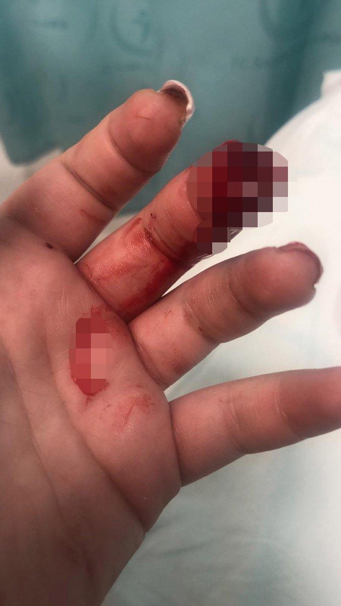 Sinop'ta sandalyeye eli sıkışan kadının parmağı koptu