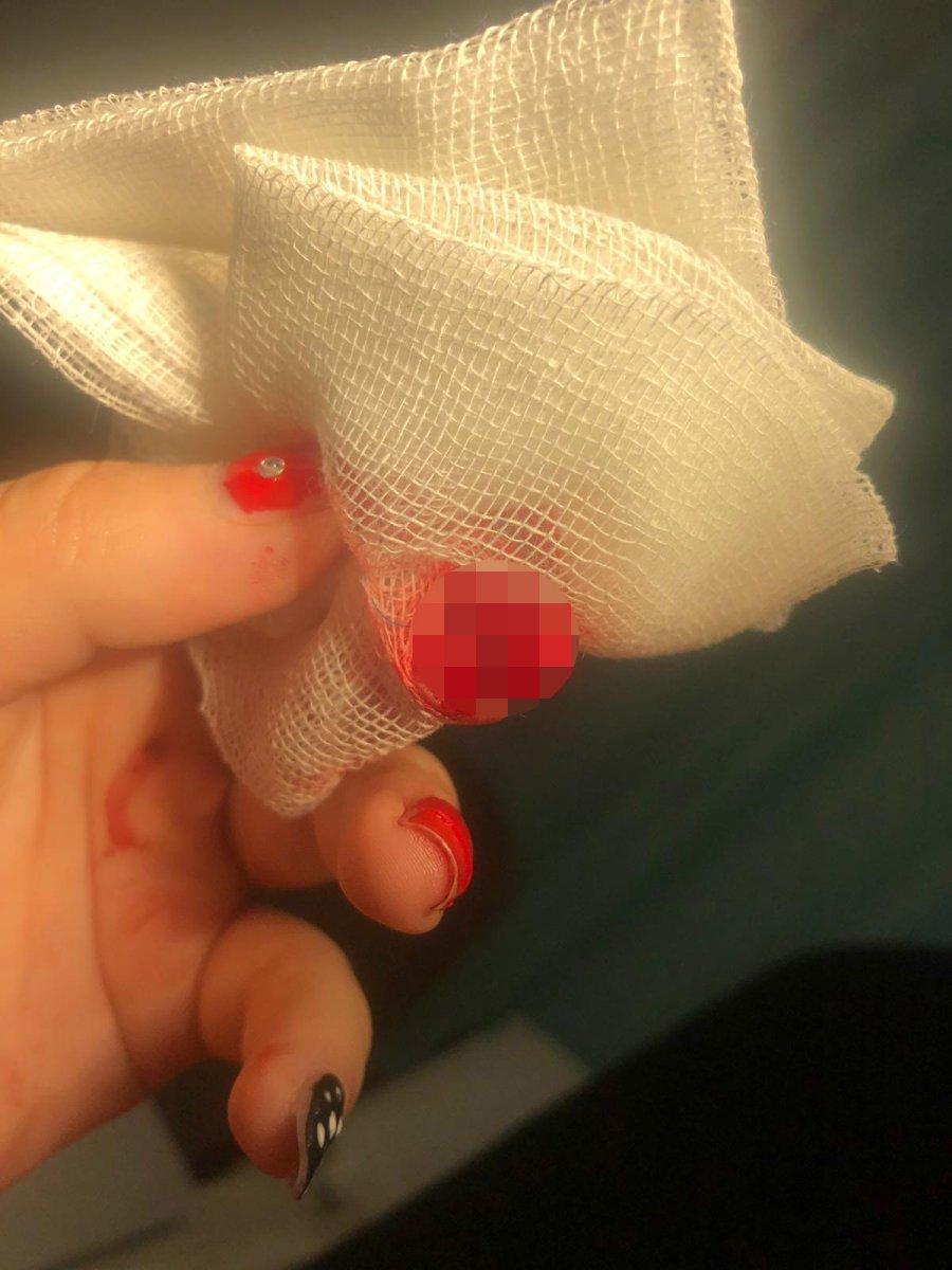 Sinop'ta sandalyeye eli sıkışan kadının parmağı koptu