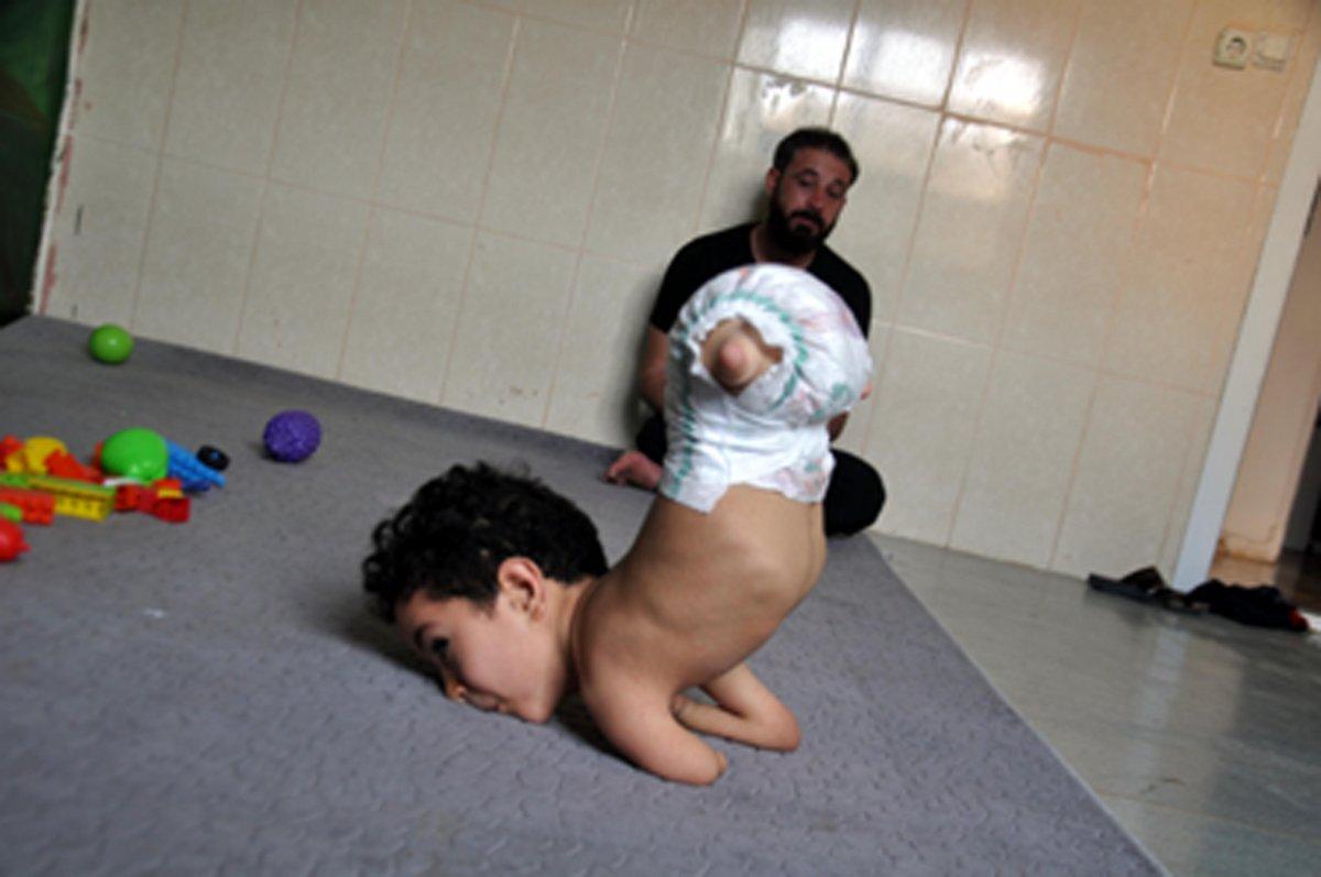 Hatay'da 2 bacağı ve 1 kolu olmayan minik Mustafa, protez istiyor