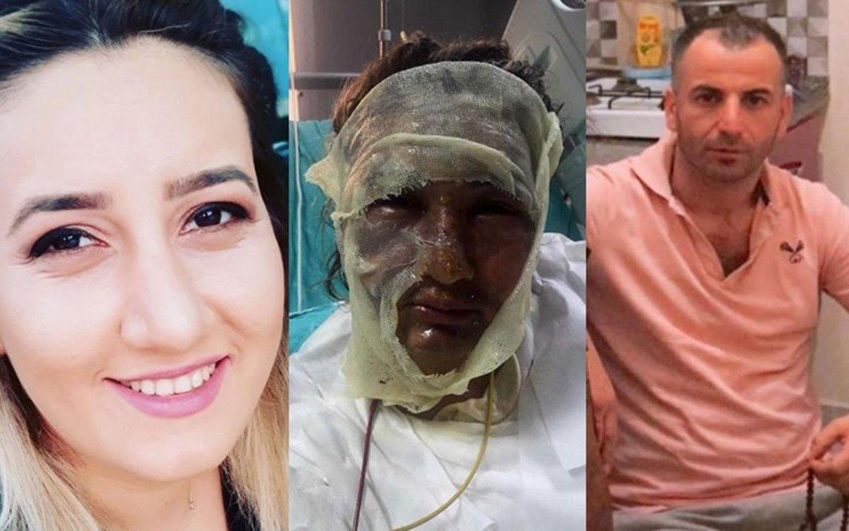 İstanbul'da yüzüne kızgın yağ attığı erkek arkadaşı ceza aldı, kadının tepkisi pes dedirtti