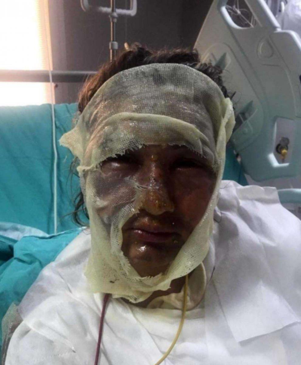 İstanbul'da yüzüne kızgın yağ attığı erkek arkadaşı ceza aldı, kadının tepkisi pes dedirtti