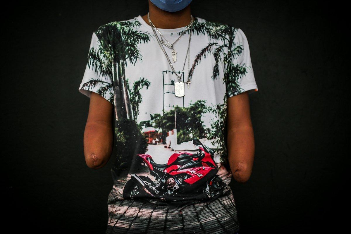 Kollarını kaybeden Kolombiyalı genç, üç boyutlu protezlerine kavuştu