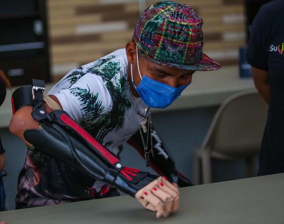 Kollarını kaybeden Kolombiyalı genç, üç boyutlu protezlerine kavuştu