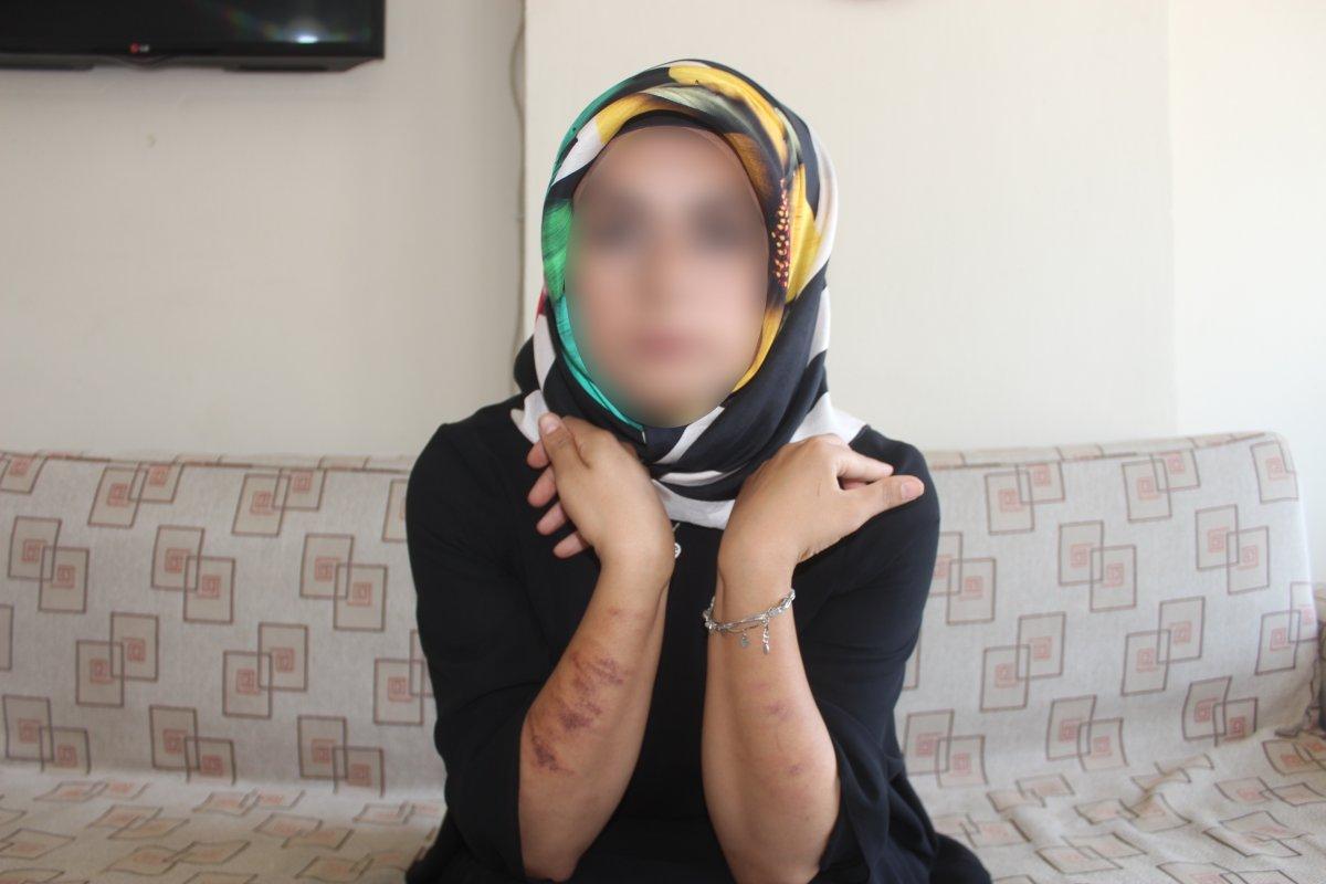 Adıyaman'da lazer yaptıran genç kadının vücudu yandı