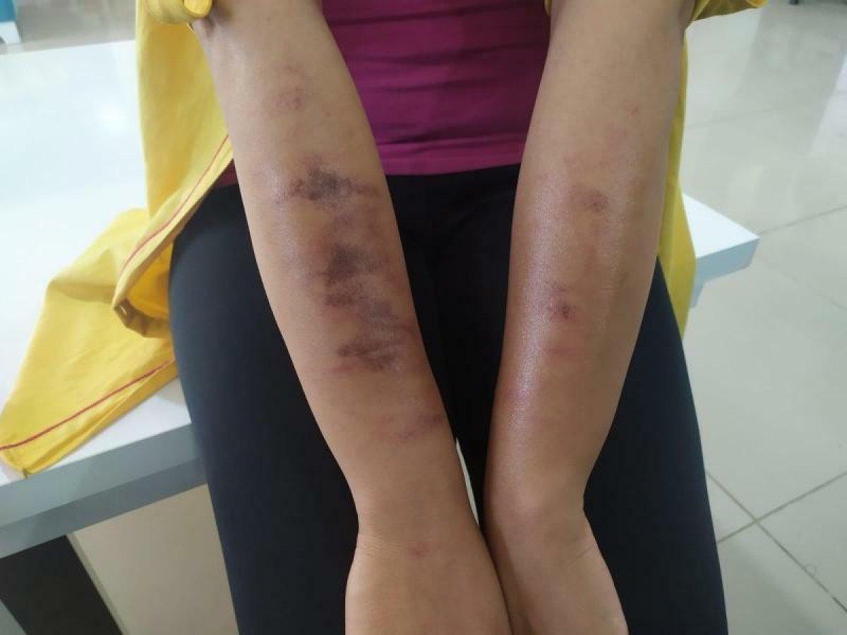 Adıyaman'da lazer yaptıran genç kadının vücudu yandı