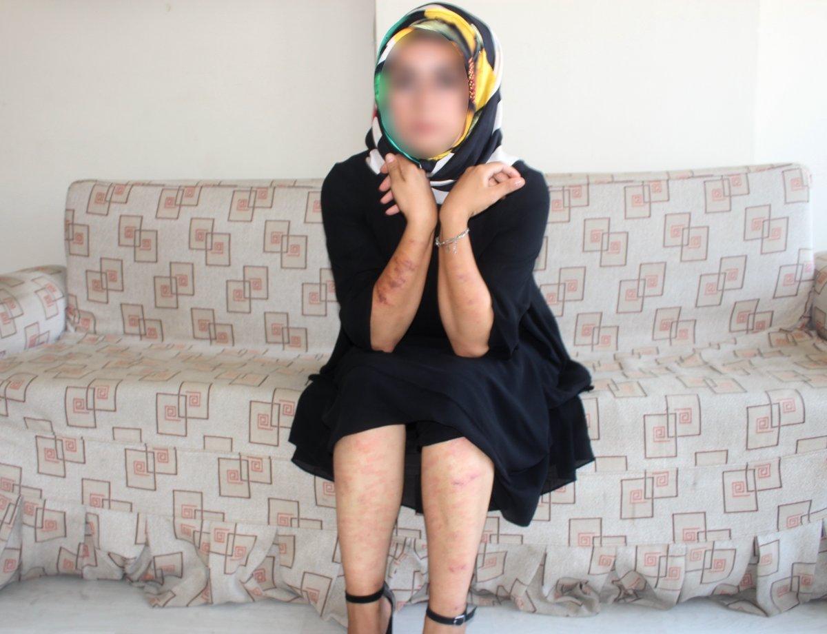 Adıyaman'da lazer yaptıran genç kadının vücudu yandı