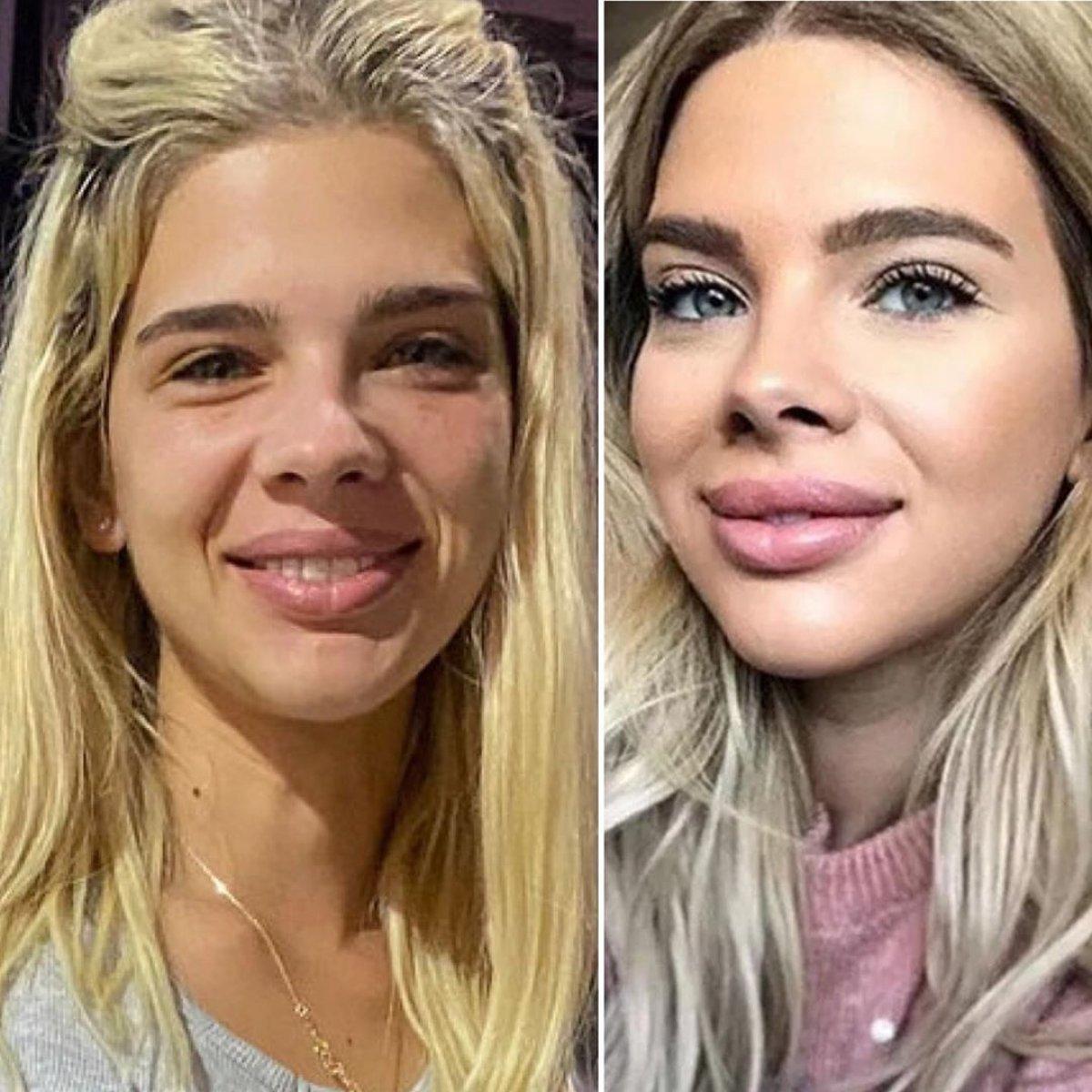 Damla Ersubaşı: Yüzüme botoks yaptırdım