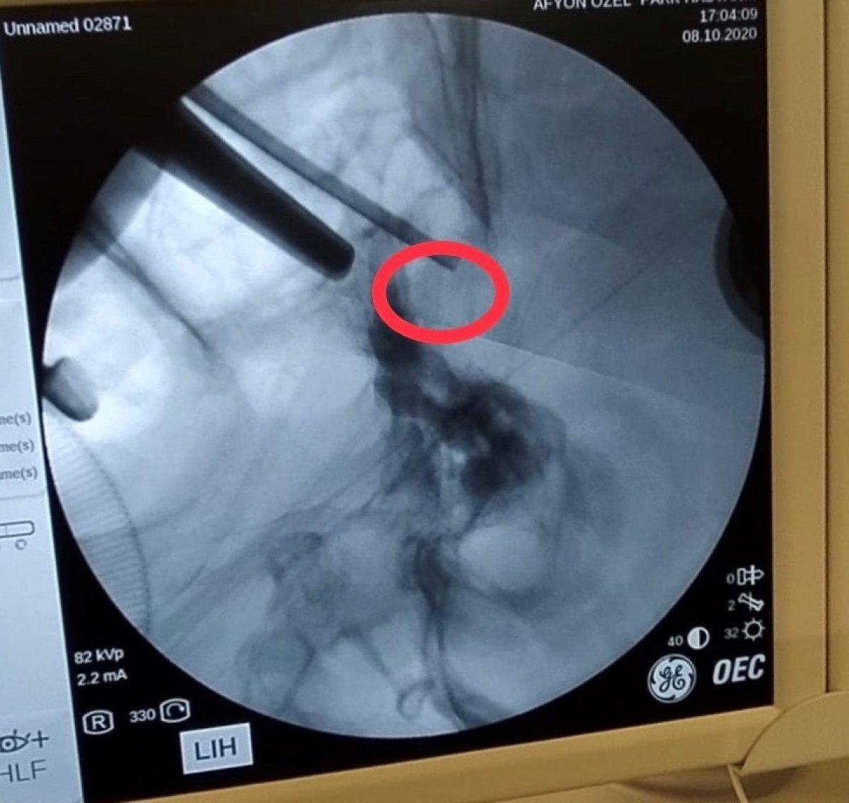Afyonkarahisar’da, hastanın beynindeki tümör burun deliğinden çıkarıldı