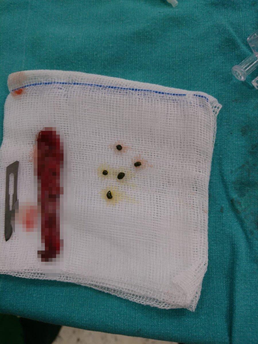 Samsun'da 1 yaşındaki bebeğin safra kesesinden 5 taş çıkarıldı