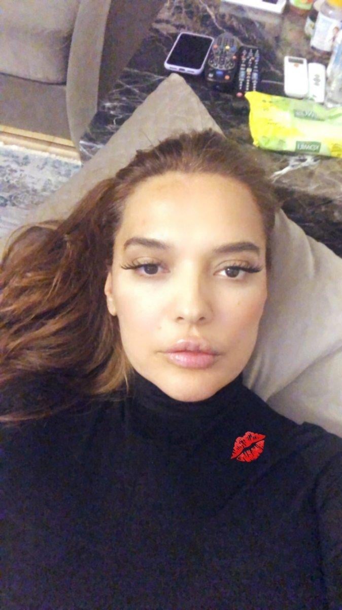 Demet Akalın, dudak dolgusu yaptırdı
