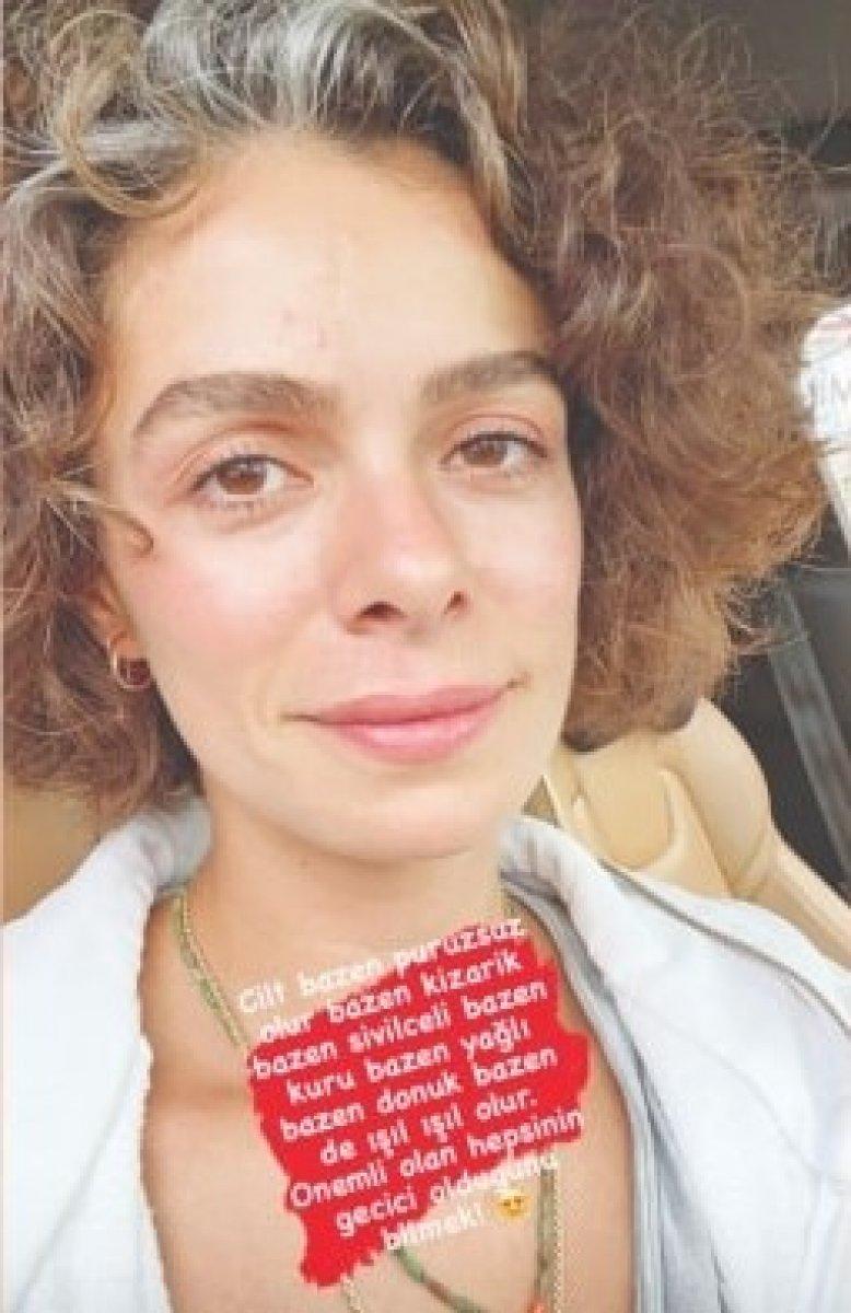 Özge Özpirinçci sivilceli halini paylaştı