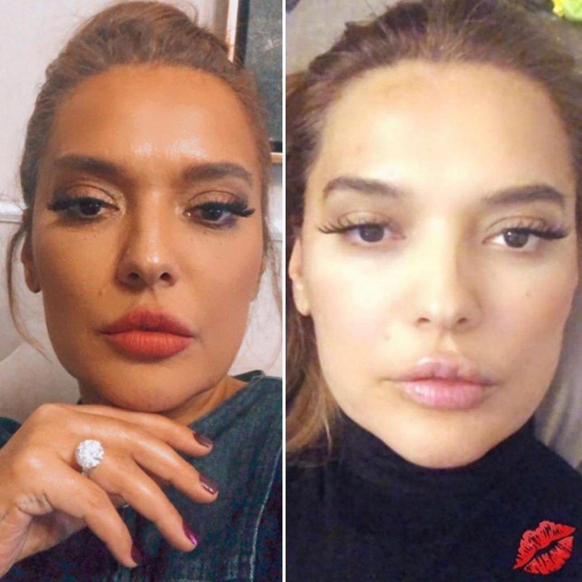 Demet Akalın, yeni dudaklarını çok beğendi