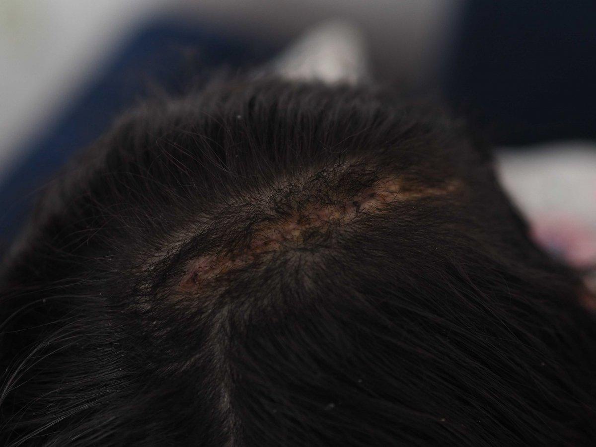 İstanbul'da forklift 9 yaşındaki kız çocuğuna çarptı