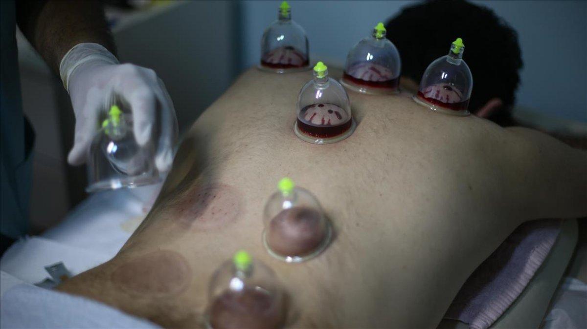 Hacamat nedir, nasıl yapılır? Hacamat hangi günler yapılır? Hacamatın faydaları nelerdir?