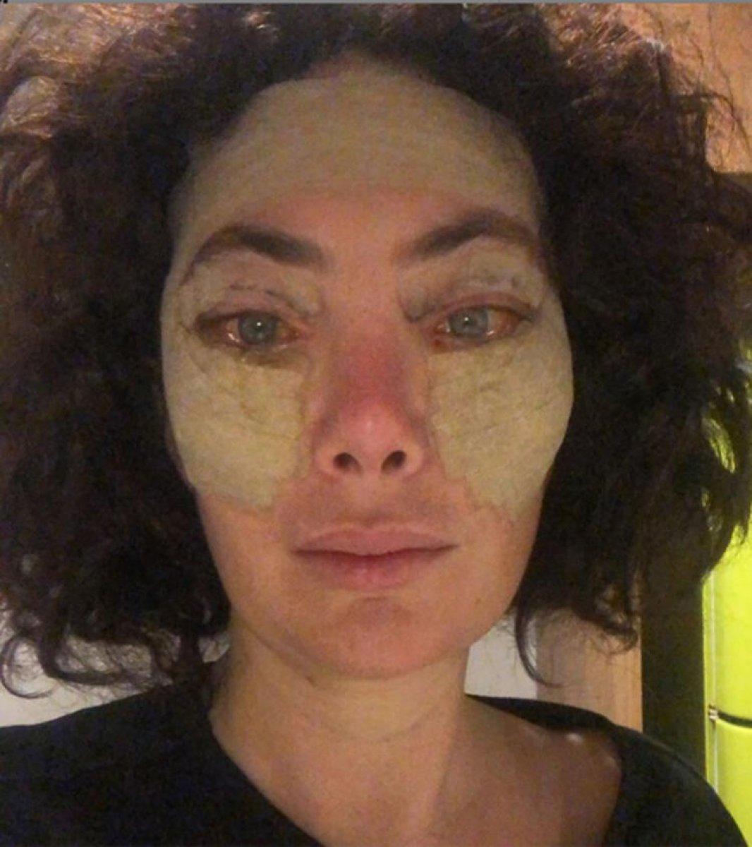 Akasya Asıltürkmen, estetik yaptırdı