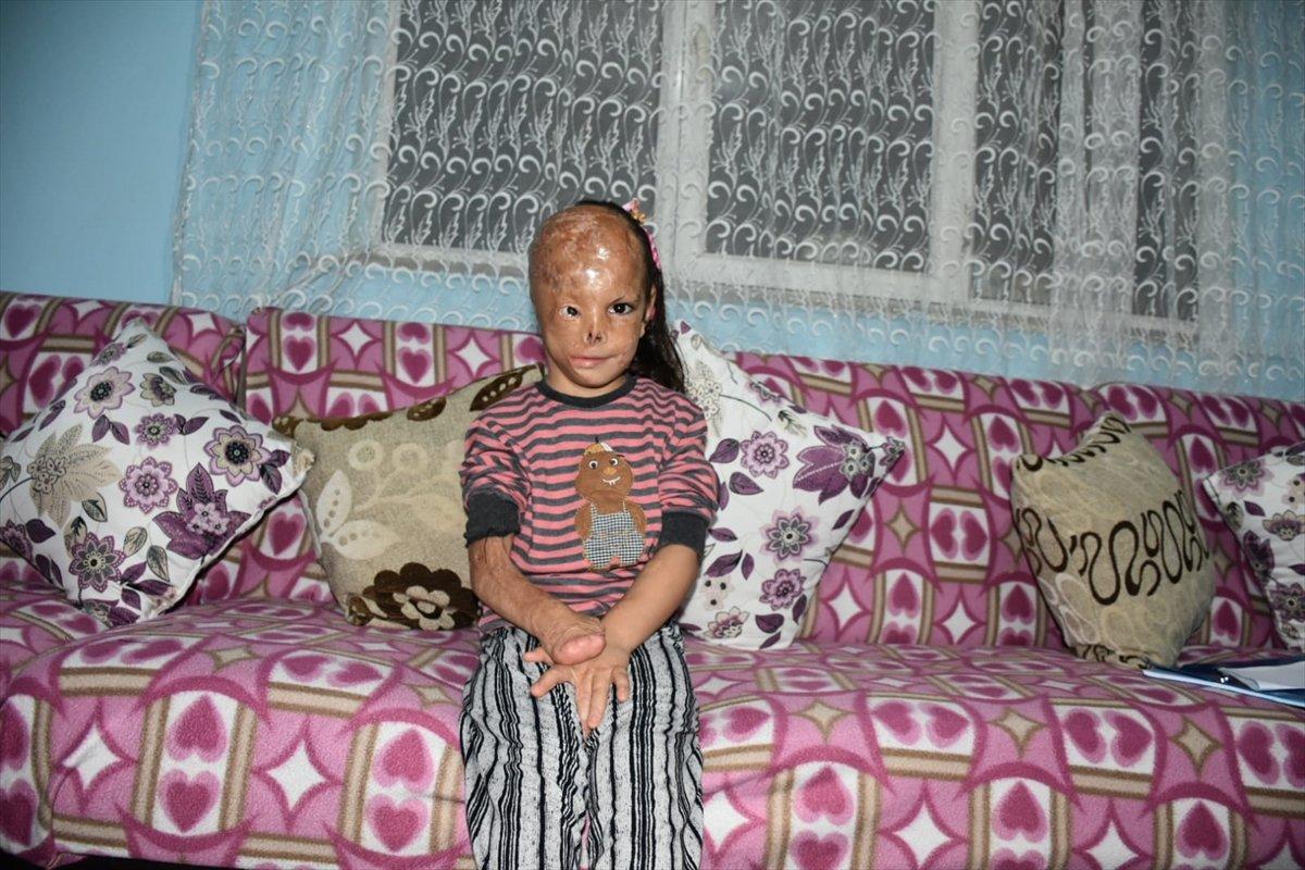 Kocaeli'de bebekken yüzü yanan Dilara yardım bekliyor