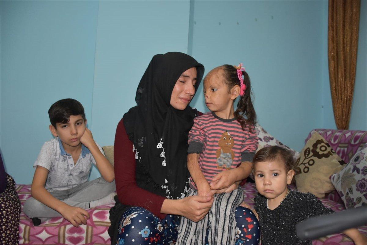 Kocaeli'de bebekken yüzü yanan Dilara yardım bekliyor