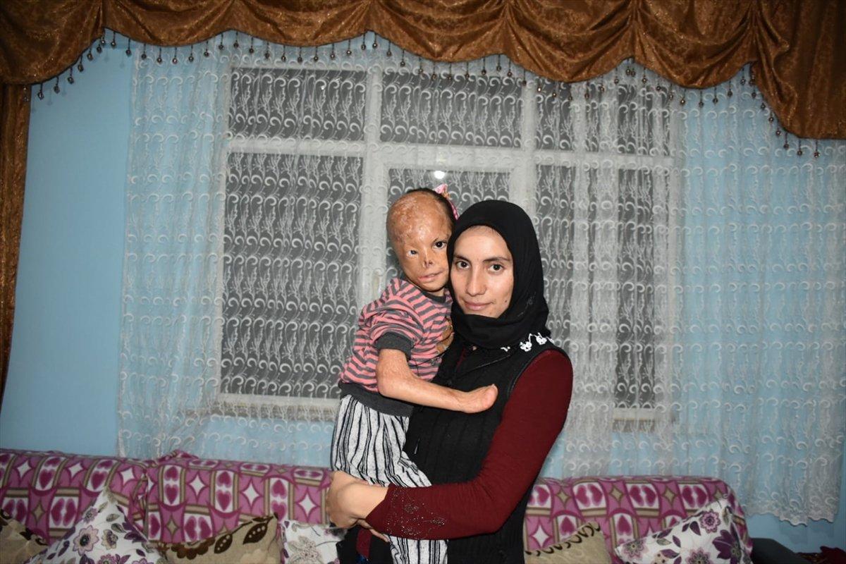 Kocaeli'de bebekken yüzü yanan Dilara yardım bekliyor