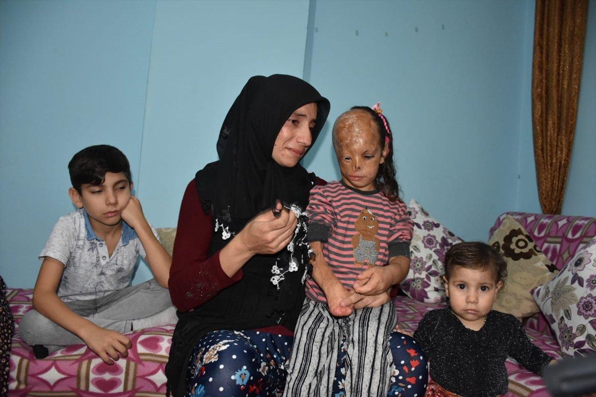 Kocaeli'de bebekken yüzü yanan Dilara yardım bekliyor