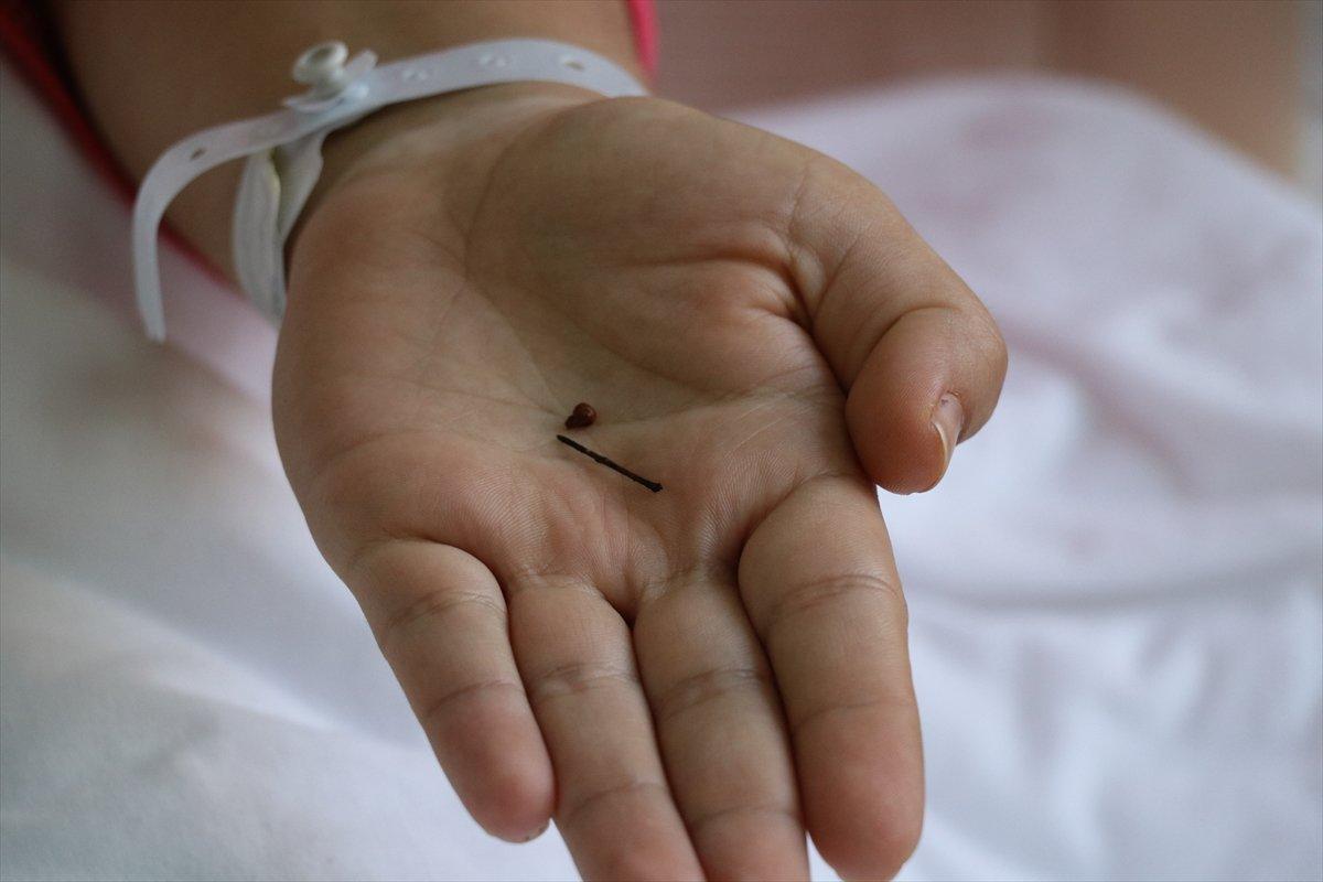 Aydınlı genç kız, yuttuğu toplu iğneden 17 yıl sonra kurtuldu