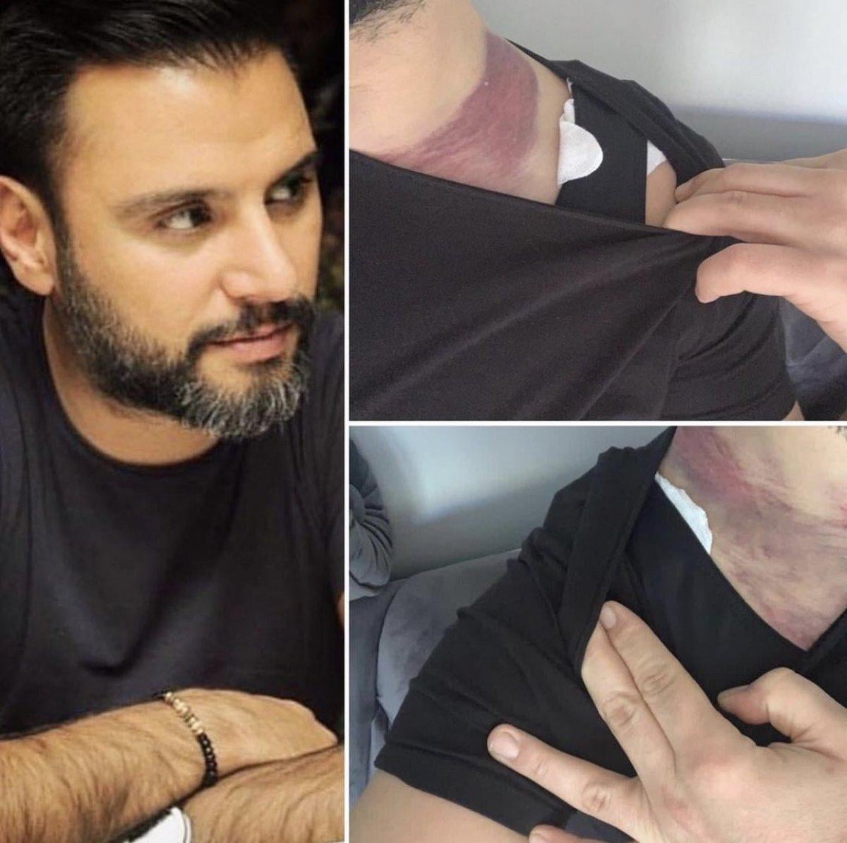 Alişan: Liposuction yaptırdım, ölümden döndüm