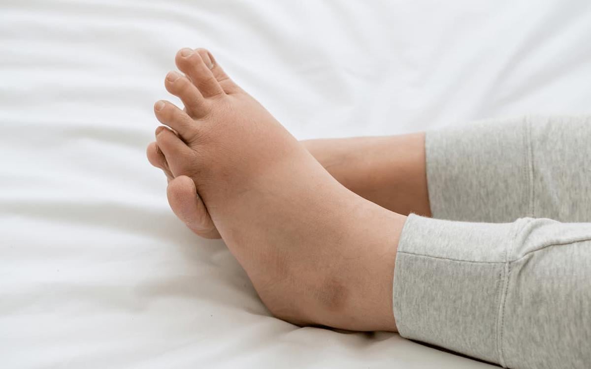 Ayak şişmesi neden olur, nasıl geçer
