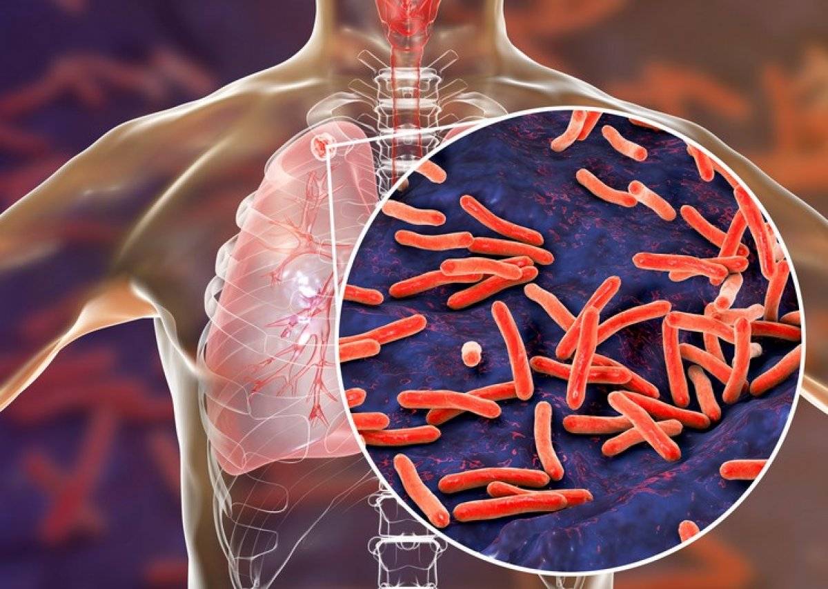 Sinsi hastalık veremin erken teşhisi hayat kurtarıyor