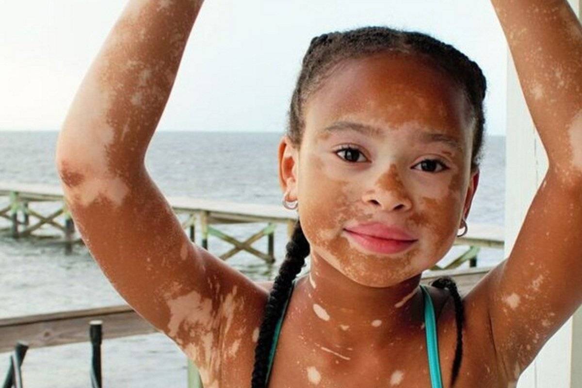 Vitiligo nedir, belirtileri nelerdir? Vitiligo tedavi edilir mi, bulaşıcı mıdır?