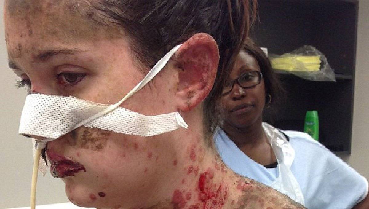 Stevens Johnson sendromu nedir? Stevens Johnson belirtileri ve nedenleri nelerdir?