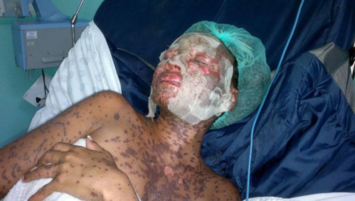 Stevens Johnson sendromu nedir? Stevens Johnson belirtileri ve nedenleri nelerdir?