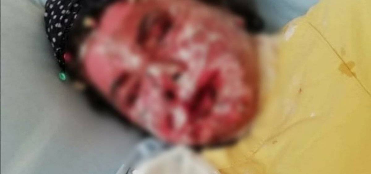 Stevens Johnson sendromu nedir? Stevens Johnson belirtileri ve nedenleri nelerdir?