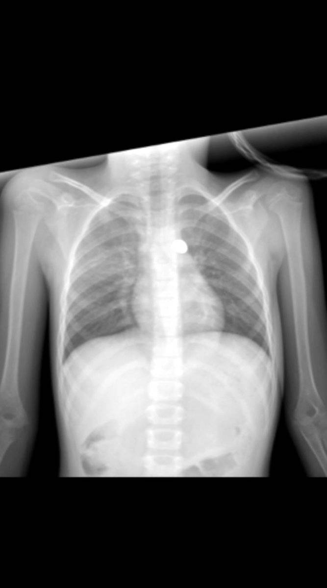 Adana'da maganda kurşunu küçük kıza isabet etti